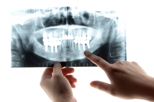 歯科衛生士はX線（レントゲン）のボタンは絶対押しちゃダメ！違法行為になってしまいます！
